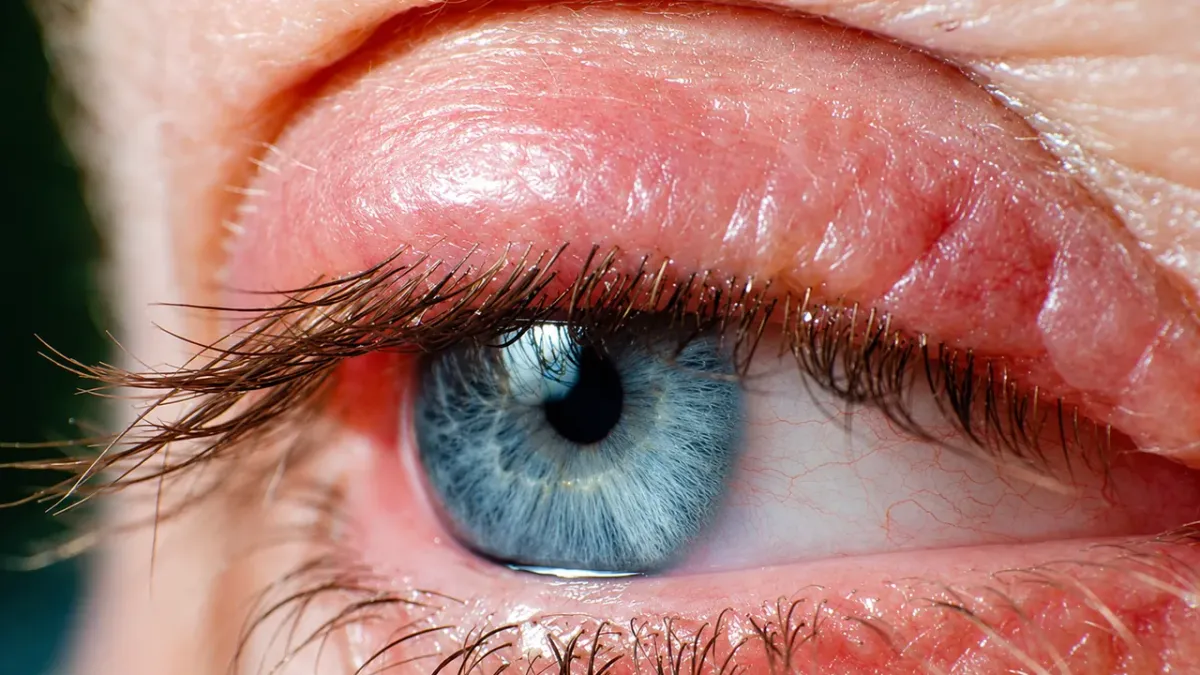 Palpebra arrossata con segni di blefarite sul bordo palpebrale