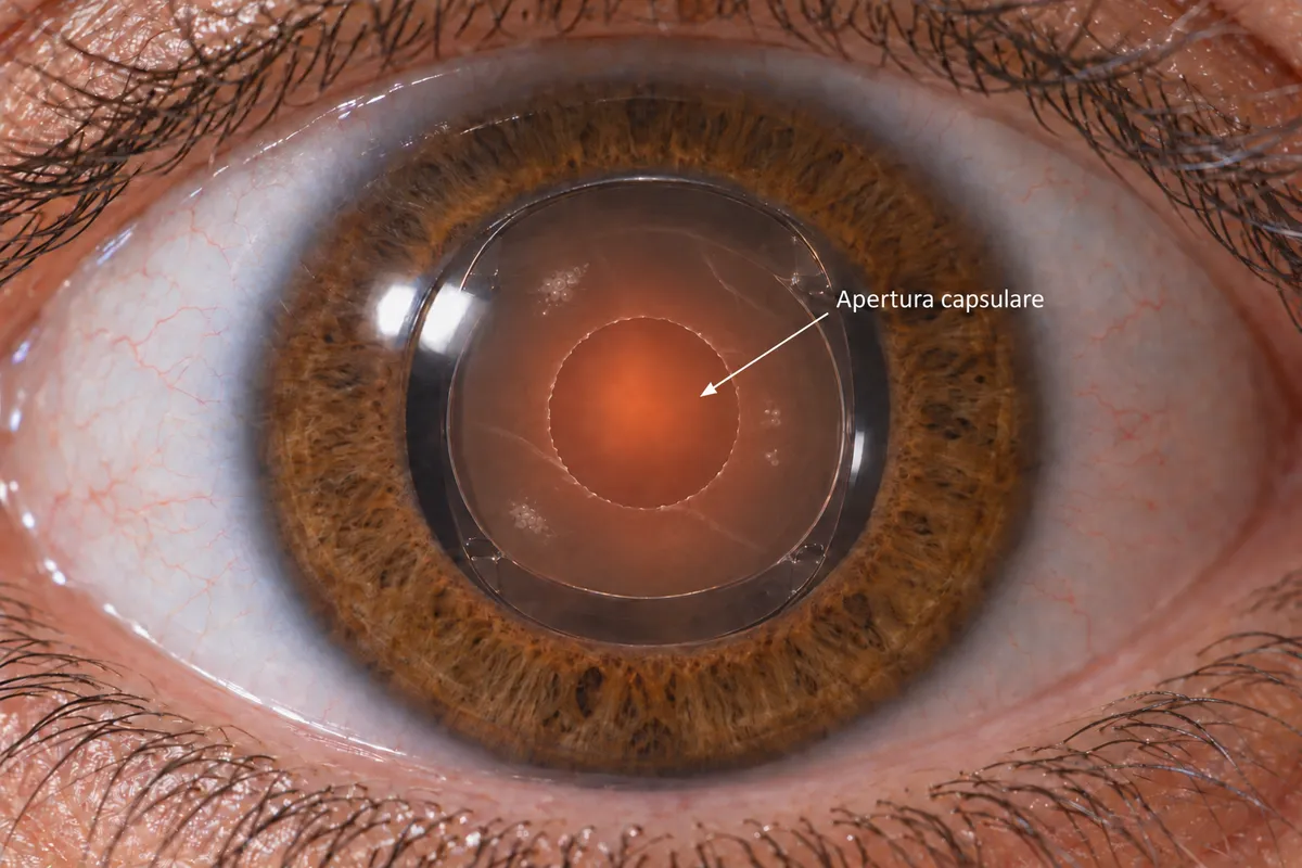 Illustrazione della capsula posteriore opacizzata e del trattamento laser YAG