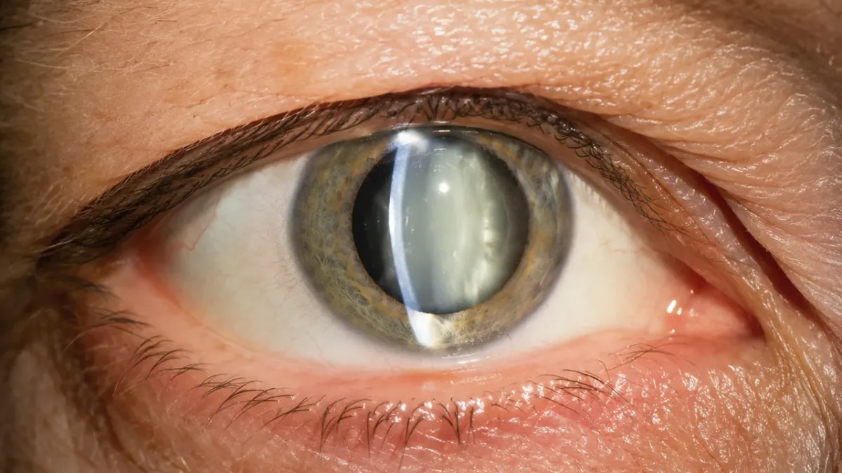 Cristallino opacizzato in un occhio con cataratta