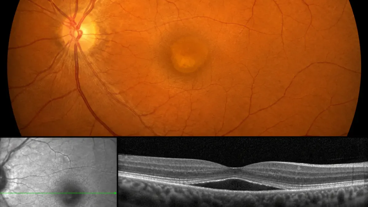 Rappresentazione della macula con liquido nella corioretinopatia sierosa centrale