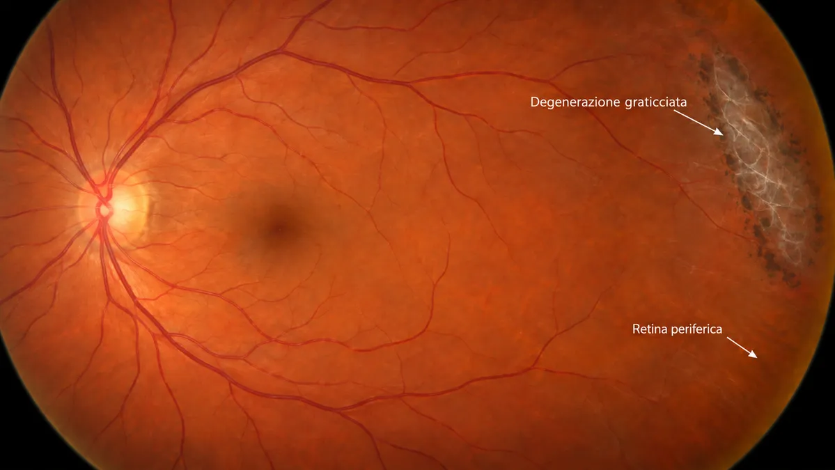 Illustrazione della degenerazione graticciata della retina periferica