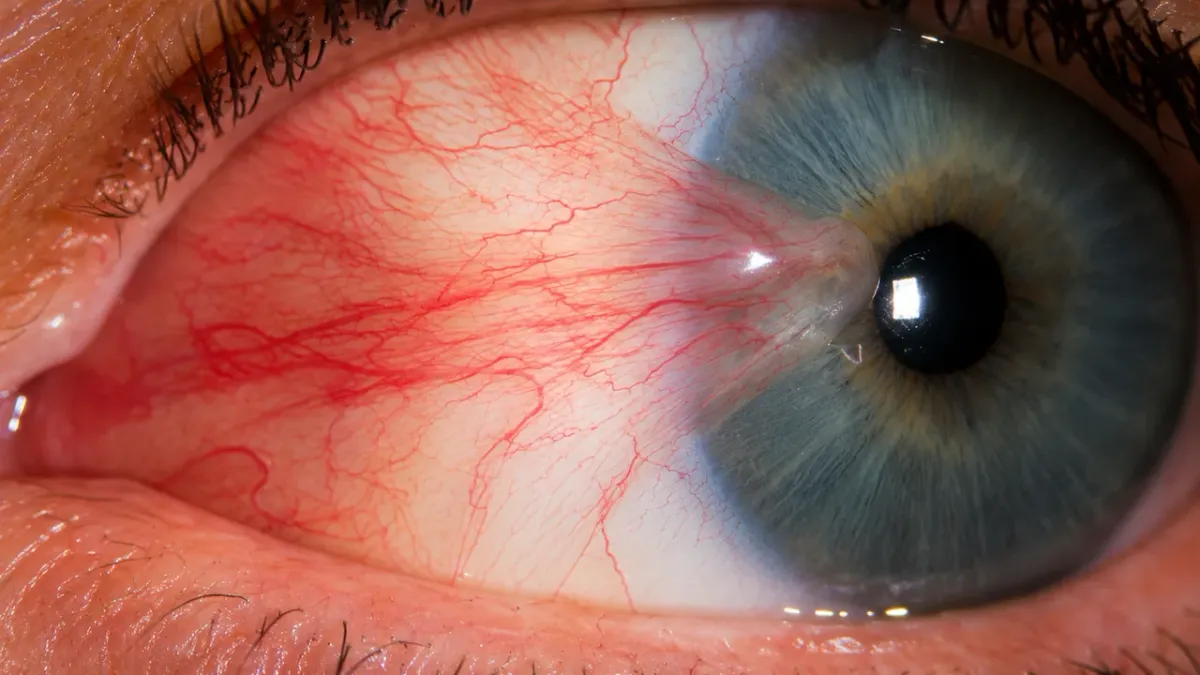 Pterigio che cresce dalla congiuntiva verso la cornea
